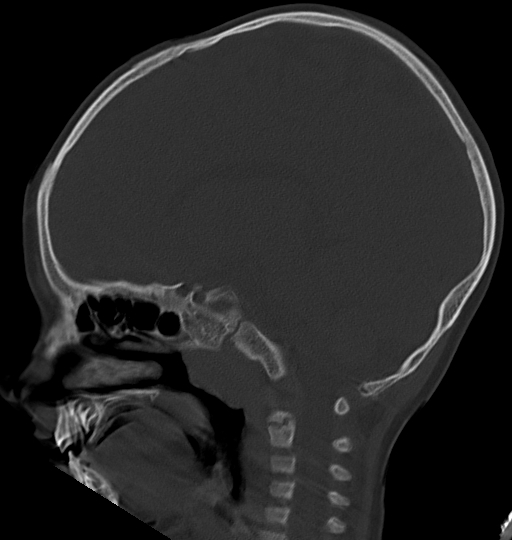 File:Acute mastoiditis (Radiopaedia 82678-96881 Sagittal bone window 29).jpg