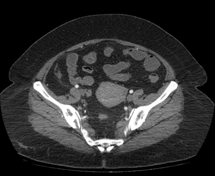 Acute mesenteric ischemia (Radiopaedia 80029-93316 Axial C+ arterial phase 106).jpg