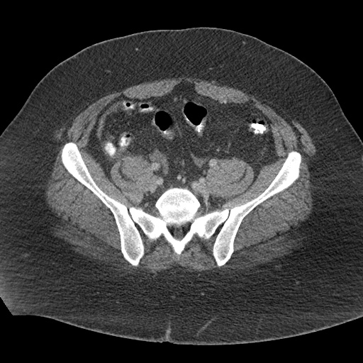 Acute mesenteric venous ischemia (Radiopaedia 46041-50383 Axial C+ portal venous phase 104).jpg