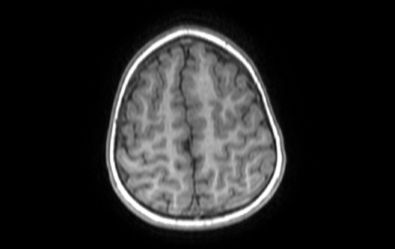 File:Acute necrotizing encephalitis of childhood (Radiopaedia 67356-76737 Axial T1 16).jpg