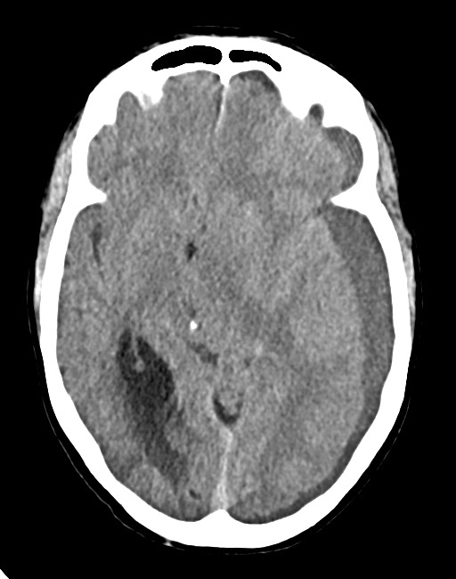 Acute on chronic subdural hematoma (Radiopaedia 74814-85823 Axial non-contrast 43).jpg