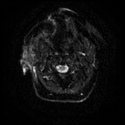Acute otitis externa (Radiopaedia 57296-64236 Axial DWI 43).jpg