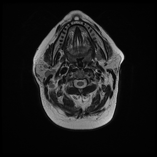 File:Acute otitis externa (Radiopaedia 57296-64236 Axial T2 16).jpg