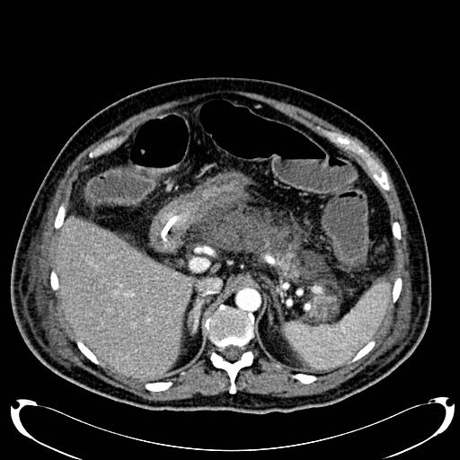 Acute pancreatic necrosis (Radiopaedia 13560-18500 Axial C+ portal venous phase 47).jpg