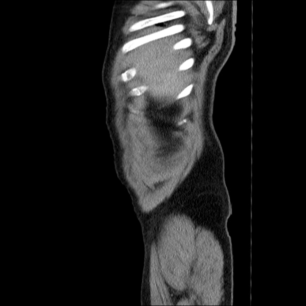 Acute pancreatitis (Radiopaedia 26663-26813 Sagittal C+ portal venous phase 6).jpg