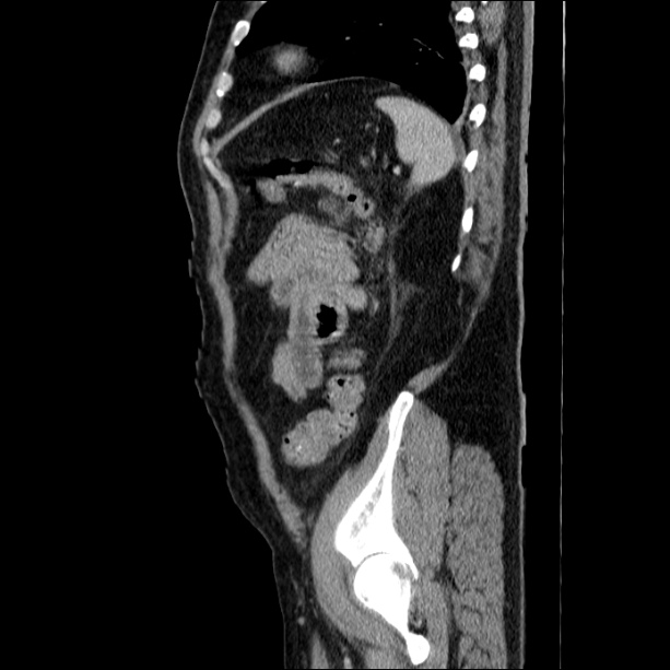 Acute pancreatitis (Radiopaedia 26663-26813 Sagittal C+ portal venous phase 61).jpg