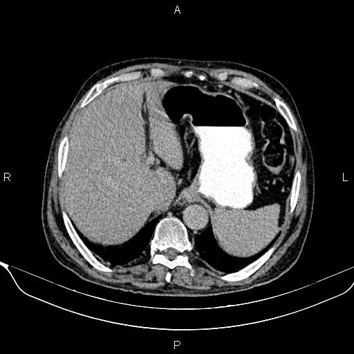 File:Acute pancreatitis (Radiopaedia 85146-100701 Axial C+ delayed 15).jpg