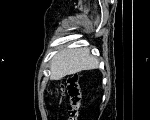 Acute pancreatitis (Radiopaedia 85146-100701 Sagittal C+ portal venous phase 8).jpg