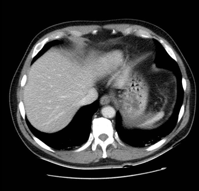 Acute pancreatitis - Balthazar E (Radiopaedia 23080-23110 Axial C+ portal venous phase 8).jpg