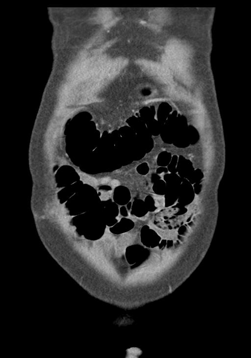 Acute pancreatitis and walled-off necrosis (Radiopaedia 29888-30403 E 10).jpg