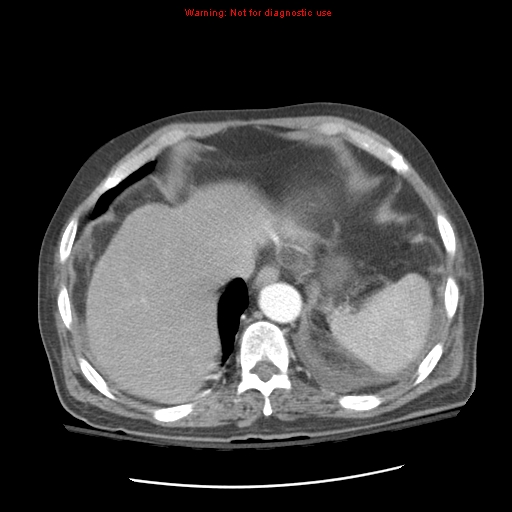 Acute pancreatitis with incidental pancreatic lipoma (Radiopaedia 10190-10730 Axial C+ arterial phase 16).jpg