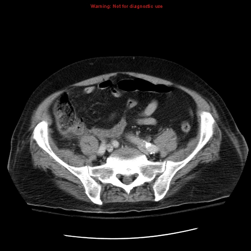 File:Acute pancreatitis with incidental pancreatic lipoma (Radiopaedia 10190-10730 Axial C+ portal venous phase 57).jpg