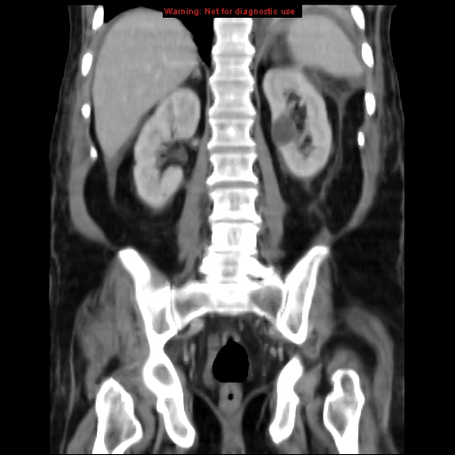 Acute pancreatitis with incidental pancreatic lipoma (Radiopaedia 10190-10730 Coronal C+ portal venous phase 52).jpg