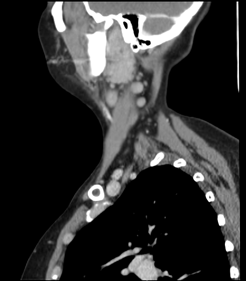 File:Acute parotitis (Radiopaedia 27425-27619 Sagittal C+ portal venous phase 14).png