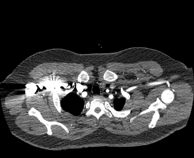 Acute pulmonary embolism with pulmonary infarcts (Radiopaedia 77688-89908 Axial C+ CTPA 2).jpg