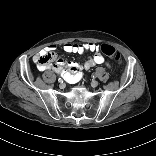 Acute renal infarction - rim capsular enhancement (Radiopaedia 59833-67270 Axial C+ portal venous phase 75).jpg