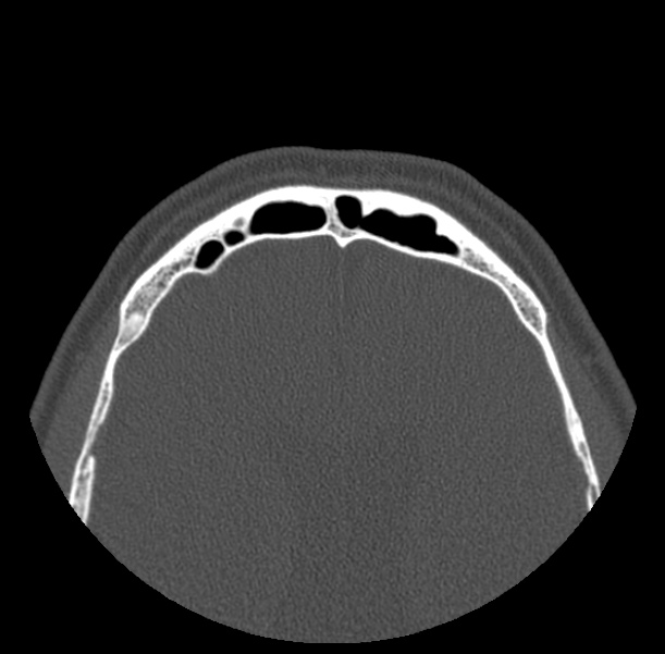 Acute sinusitis (Radiopaedia 23161-23215 Axial bone window 73).jpg