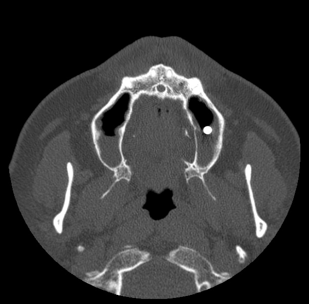Acute sinusitis (Radiopaedia 23161-23215 Axial bone window 8).jpg