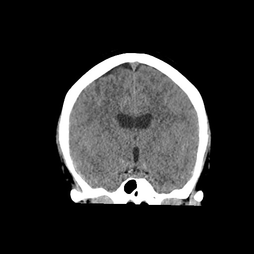 Acute subarachnoid hemorrhage and accessory anterior cerebral artery (Radiopaedia 69231-79008 Coronal non-contrast 35).jpg