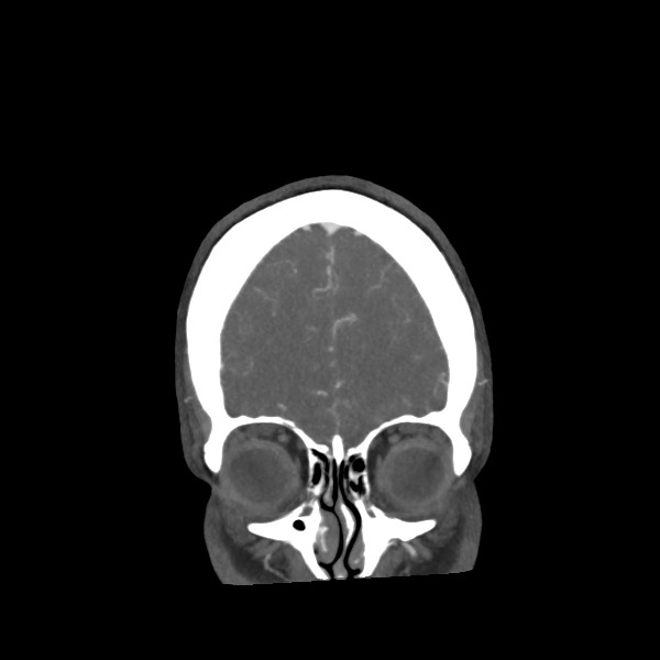 Acute subarachnoid hemorrhage and accessory anterior cerebral artery (Radiopaedia 69231-79009 Coronal C+ arterial phase 17).jpg