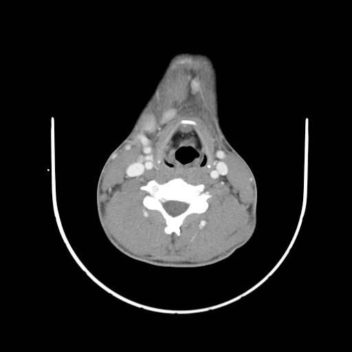 File:Acute submandibular sialadenitis secondary to ductal stone (Radiopaedia 27999-28267 Axial C+ delayed 31).jpg