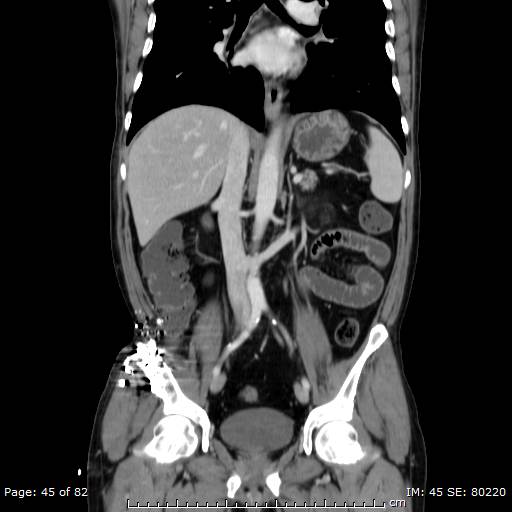 Acute superior mesenteric artery occlusion (Radiopaedia 43636-47060 Coronal C+ portal venous phase 30).jpg