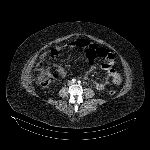 File:Acute superior mesenteric artery occlusion (Radiopaedia 51288-56960 Axial C+ arterial phase 53).jpg