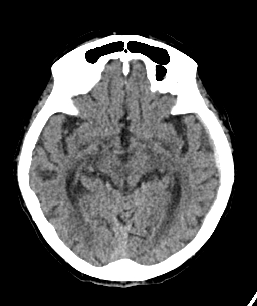 Acute traumatic subdural hematoma (Radiopaedia 82921-97257 Axial non-contrast 39).jpg