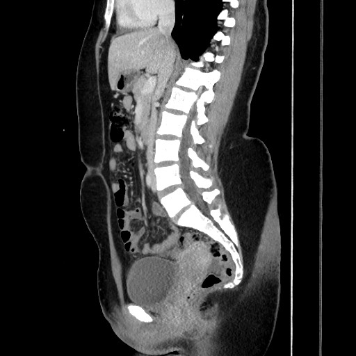 File:Acute uncomplicated appendicitis (Radiopaedia 73704-84499 Sagittal C+ portal venous phase 109).jpg
