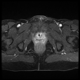 File:Adenocarcinoma arising in a urethral diverticulum (Radiopaedia 12400-12657 Axial T1 C+ fat sat 9).jpg