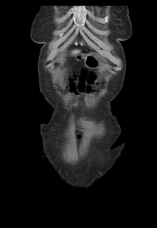 Adenocarcinoma of cecum (Radiopaedia 59222-66549 Coronal C+ portal venous phase 2).jpg