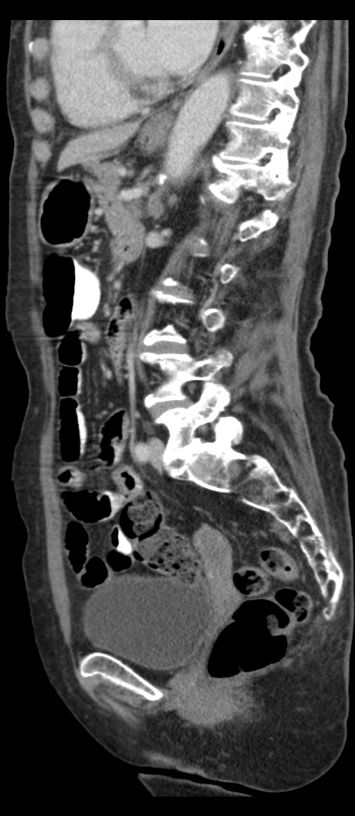 Adenocarcinoma of cecum (Radiopaedia 59222-66549 Sagittal C+ portal venous phase 37).jpg