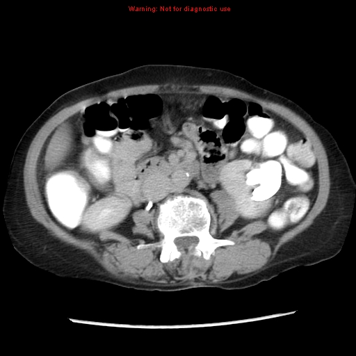 File:Adenocarcinoma of the colon (Radiopaedia 8191-9039 Axial renal excretory phase 23).jpg