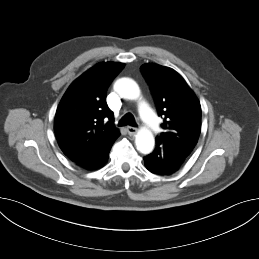 Adenocarcioma of rectum- T1 lesion (Radiopaedia 36921-38547 Axial C+ arterial phase 22).png