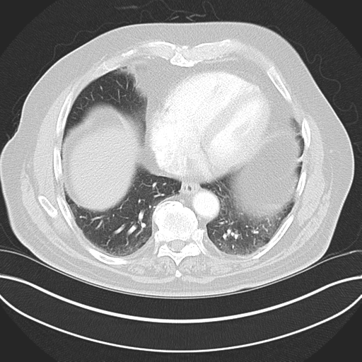 Adenocarcioma of rectum- T1 lesion (Radiopaedia 36921-38547 Axial lung window 40).png