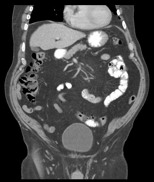 Adenocarcioma of rectum- T1 lesion (Radiopaedia 36921-38547 Coronal C+ portal venous phase 23).png