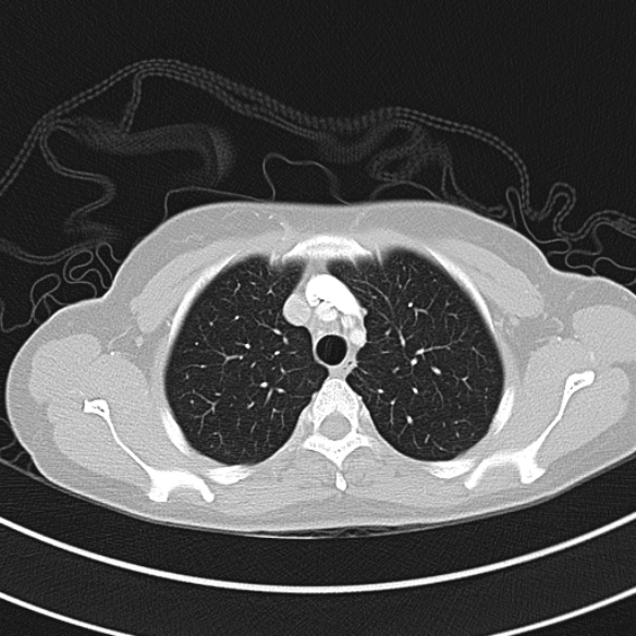 File:Adenocystic carcinoma of the trachea (Radiopaedia 47677-52525 Axial lung window 38).jpg