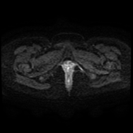 Adenoma malignum of cervix (Radiopaedia 66441-75705 Axial DWI 50).jpg