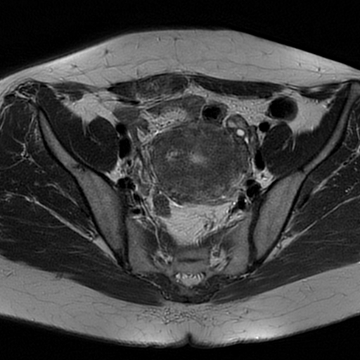 File:Adenomyosis-scar endometriosis (Radiopaedia 65863-75022 Axial T2 10).jpg