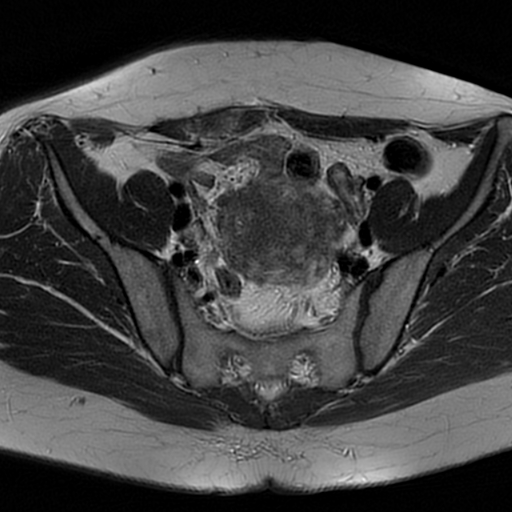 File:Adenomyosis-scar endometriosis (Radiopaedia 65863-75022 Axial T2 9).jpg