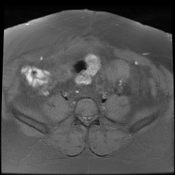 File:Adenomyosis within a didelphys uterus (Radiopaedia 70175-80215 Axial T1 fat sat 14).jpg