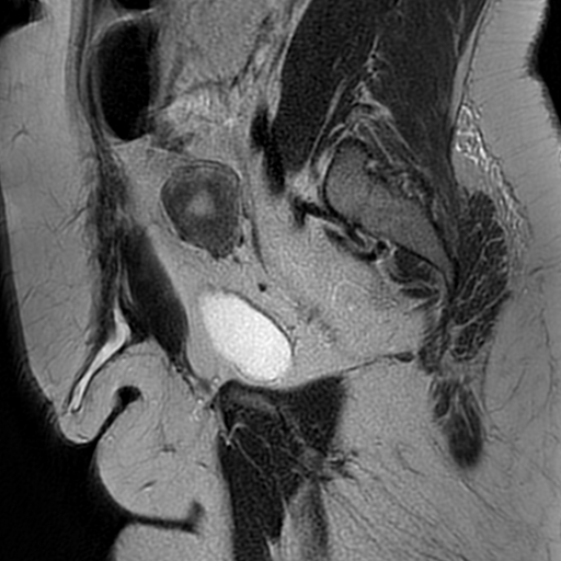 File:Adenomyosis within a didelphys uterus (Radiopaedia 70175-80215 Sagittal T2 11).jpg