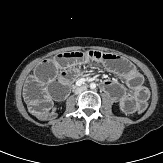 Adhesional small bowel obstruction (Radiopaedia 48397-53305 Axial C+ portal venous phase 43).jpg