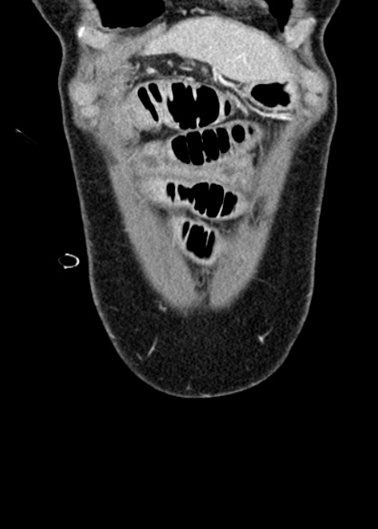 Adhesional small bowel obstruction (Radiopaedia 48397-53305 Coronal C+ portal venous phase 46).jpg