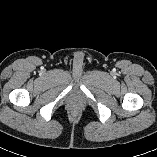 Adhesional small bowel obstruction (Radiopaedia 58900-66131 Axial C+ portal venous phase 57).jpg