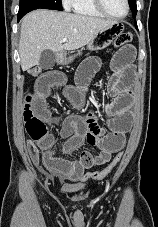 Adhesional small bowel obstruction (Radiopaedia 58900-66131 Coronal C+ portal venous phase 104).jpg