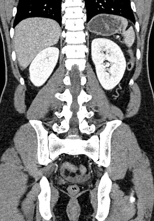 Adhesional small bowel obstruction (Radiopaedia 58900-66131 Coronal C+ portal venous phase 185).jpg