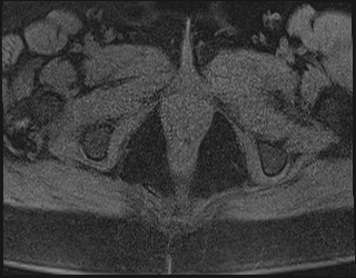 File:Adnexal multilocular cyst (O-RADS US 3. O-RADS MRI 3) (Radiopaedia 87426-103754 Axial 220).jpeg