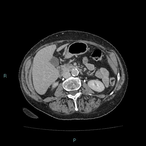 File:Adrenal collision tumor (ACT) (Radiopaedia 48462-53379 Axial C+ delayed 31).jpg
