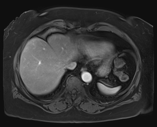 Adrenal cortical carcinoma (Radiopaedia 64017-72770 I 8).jpg